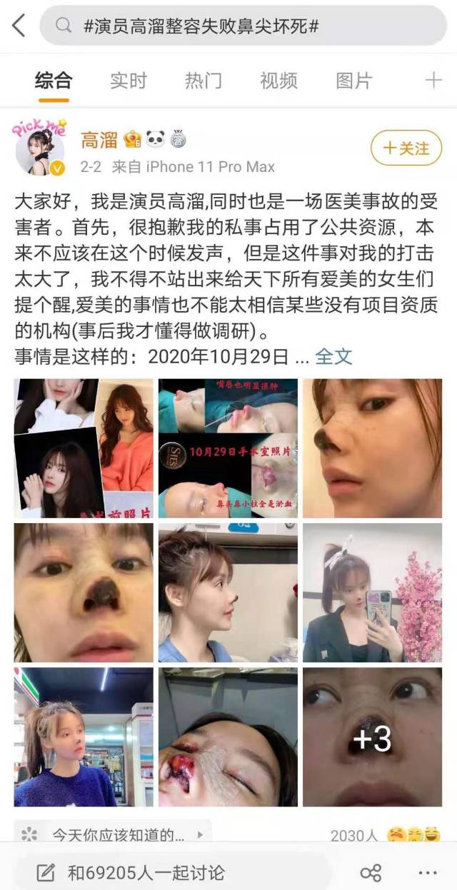 女演员在广州整容失败鼻尖坏死，官方处理结果来了！